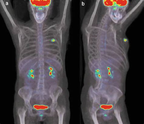 Pet Ct Scan For Kidney Cancer - CancerWalls