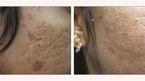 Bacne Scars Treatment