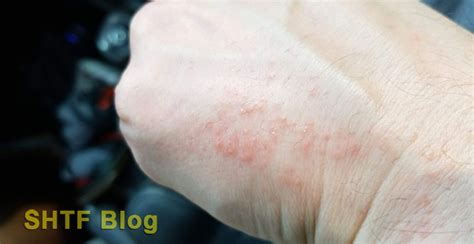 How I Treated My Browntail Moth Rash