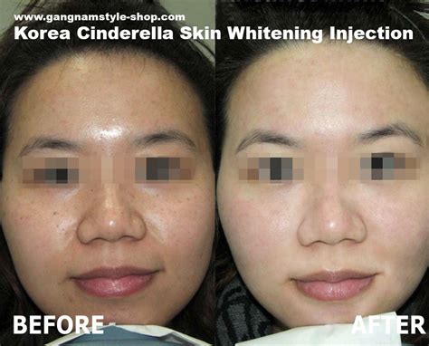 Korea Cindella skin whitening injection, most popular Glutathione injection