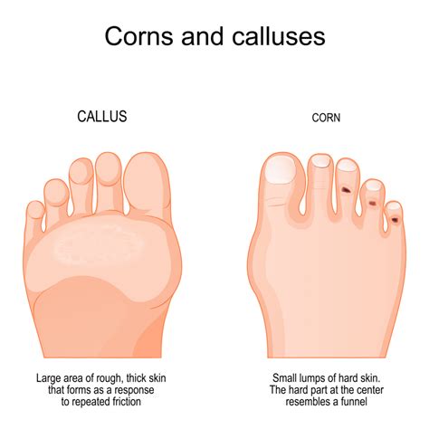 University Podiatry Associates | Calluses and Corns in Davie