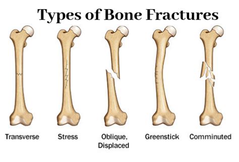 6 Types Of Fractures