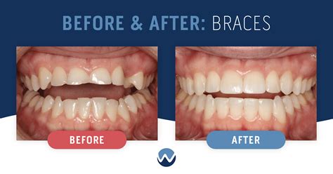 Before & After Braces: See the Amazing Results Yourself! • Woodhill ...