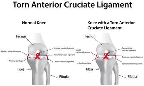 ACL Reconstruction (To Treat an Anterior Cruciate Ligament Tear ...