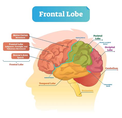 Broca's Aphasia