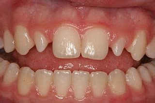 Mulberry Molars Images, Symptoms, Causes, Treatment - Health Care Tips ...