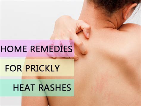 Home Remedies For Prickly Heat Rashes - Boldsky.com