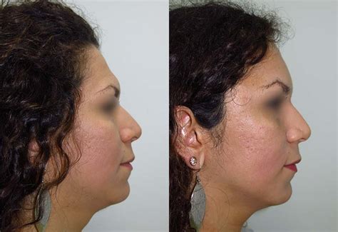 Brow bone reduction in facial feminisation surgery