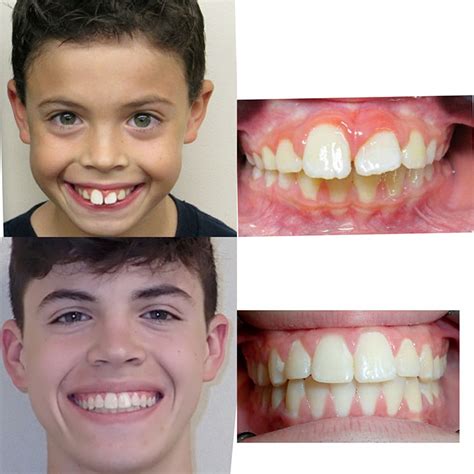 Before & After Braces | Wazio Orthodontics