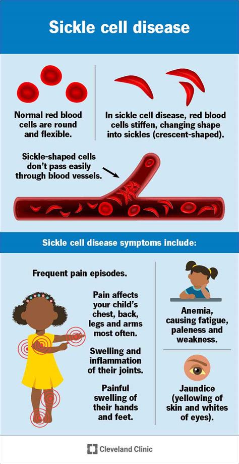 Sickle Cell Disease (SCD): Types, Symptoms & Causes