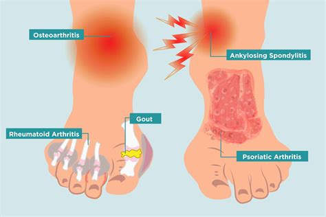 How Arthritis Strikes Your Feet, and 11 Ways to Heal Your Arthritis ...