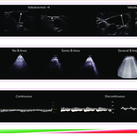 Imaging of Venous, Pulmonary and Renal Congestion by Ultrasound ...