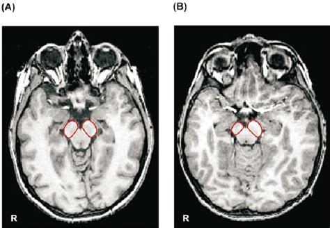 Axial (±10 mm AC±PC plane) T 1 -weighted MRI at the level of ...