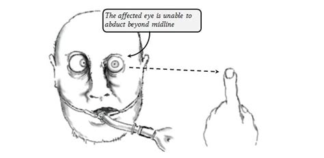 Lesions of the abducens nerve (CN VI) | Deranged Physiology