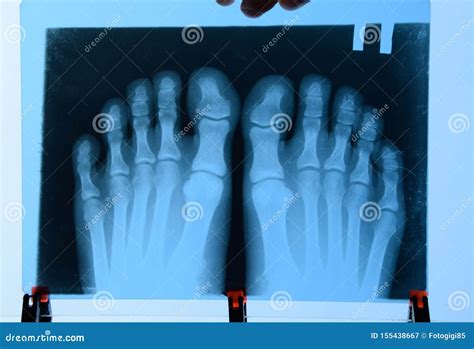 X-ray of Toes. Foot on Xray. Bone Research Stock Image - Image of ...