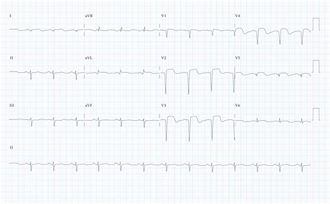 12 Lead ECG Practice Quiz v1 - SkillStat