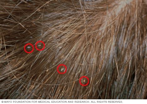 Lice - Symptoms and causes - Mayo Clinic