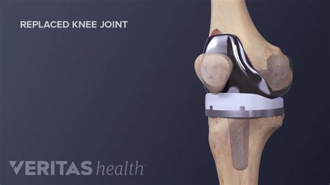 Total Knee Replacement Surgery Recovery Timeline - Althealth