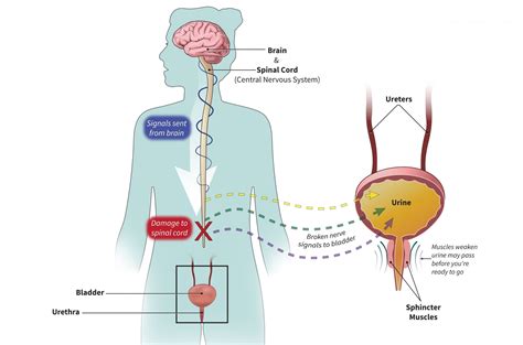 Neurogenic Bladder: Common Causes | Department of Surgery | Washington ...