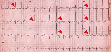 Wolff Parkinson White Syndrome - Causes, Symptoms, Treatment