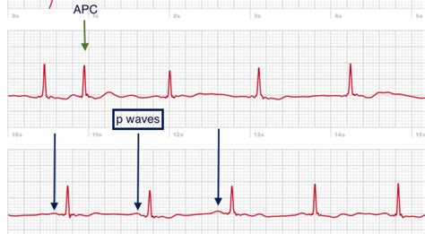 [10000ダウンロード済み√] sinus tachycardia with pac ecg 330915-How to tell the ...