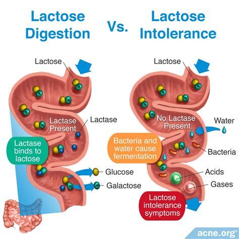 Does Lactose Intolerance Relate to Acne? - Acne.org