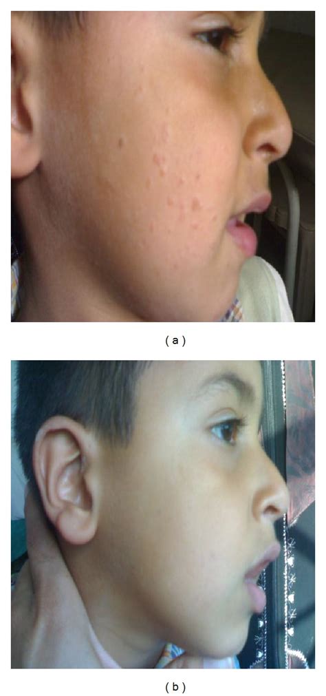 (a) A nine-year-old male with plane warts for 48 months duration before ...