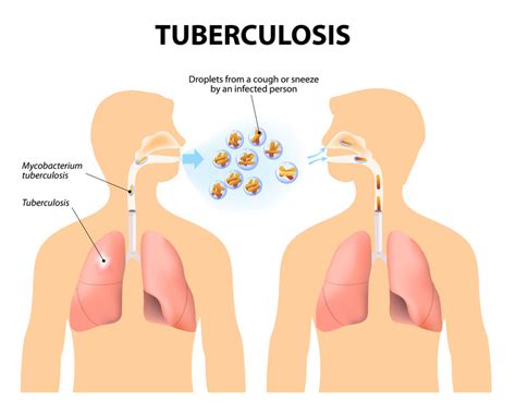 Tuberculosis - Harvard Health