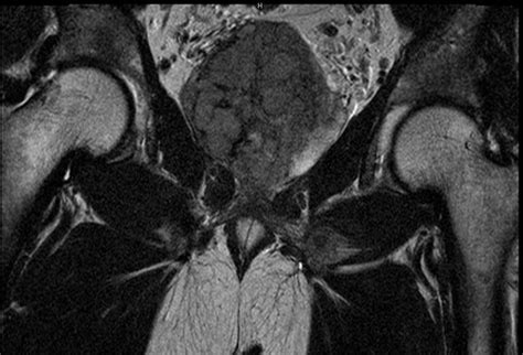 Prostate cancer MRI - wikidoc