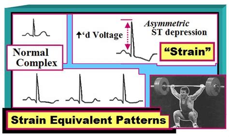 ECG Interpretation: September 2012