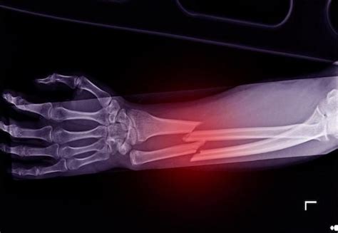 How to Know if Your Bone is Broken - Paris Orthopedics