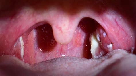 Palatine Tonsils: Function, Complications, And More, 49% OFF