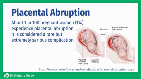 Placental Abruption | Birth Injury Guide