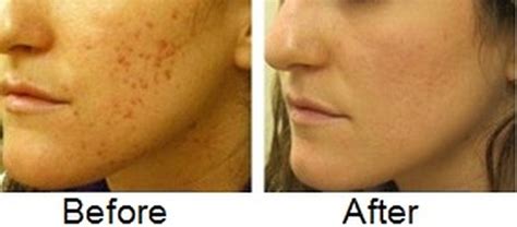 How to Fade Acne Scars Fast, Naturally, Diminish Acne Marks ...