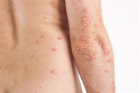 Inilah Psoriasis, Penyakit Autoimun Yang Berimbas Pada Kulit | Lifepack.id