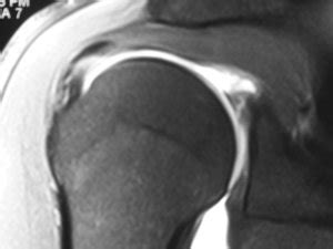 MRI of SLAP type 2 tear - Arizona Institute for Sports, Knees and Shoulders