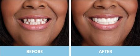 Snap On Smile Mesa, AZ | Every Smile Mesa Dentist | 85205