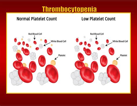 Thrombocytopenia Levels