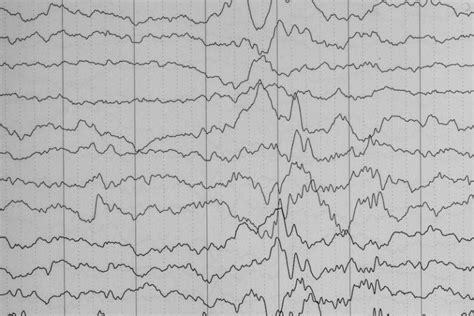 Understanding epilepsy – Teachers' Resource Magazine