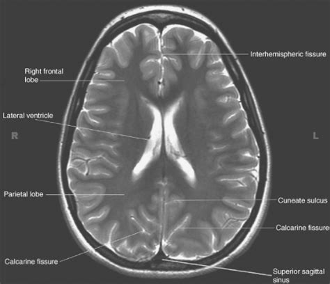 Ventricles Brain