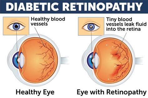 Diabetic Eye Disease Treatment in Iowa | Wolfe Eye Clinic