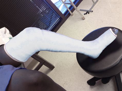 Cast Kit - Long Leg - Fiberglass - A-1 Medical Integration