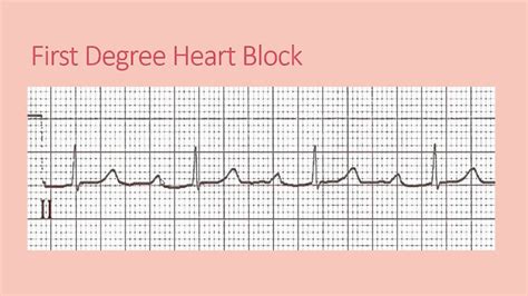 First degree heart block - YouTube