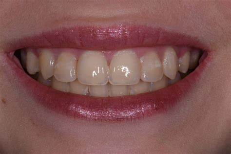 Exposed Cavities Between Front Teeth | AACD Cosmetic Dentist Auckland