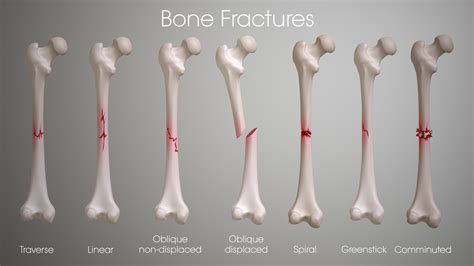 What Are The Different Types Of Bone Fractures