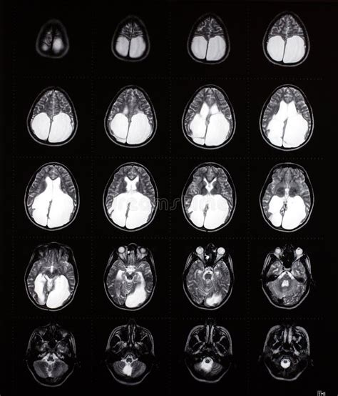 Enlarged Ventricles Brain Mri