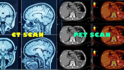 Pet Scan Vs Ct Scan Similarities And Differences | Hot Sex Picture