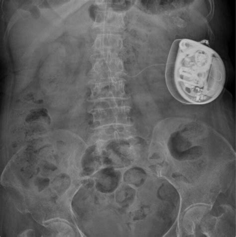 Intrathecal morphine pump implanted subcutaneously with tube insertion ...