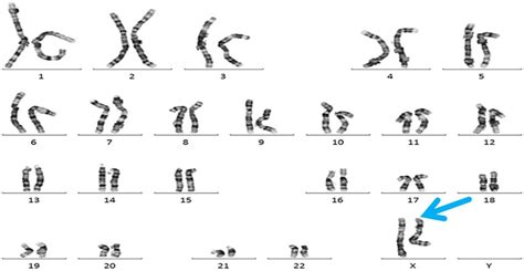 Chromosome Syndrome