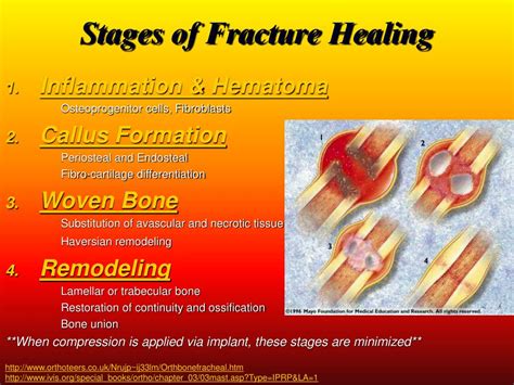 PPT - Fracture Fixation Internal & External PowerPoint Presentation ...